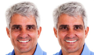 Smile-Vision | Before & After