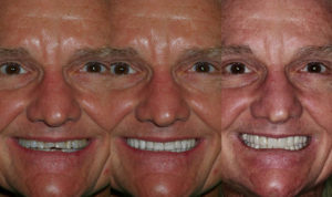 Smile-Vision | Before & After